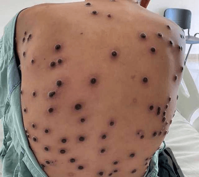 Brasil registra 90 casos confirmados de mpox; São Paulo concentra a maioria das ocorrências