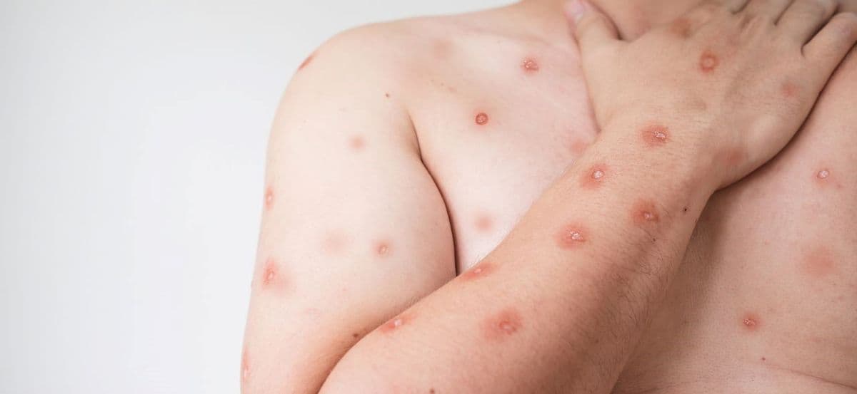 Minas Gerais registra 13 casos confirmados de Mpox e reforça monitoramento da doença